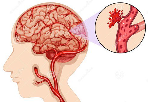 Đột quỵ do xuất huyết gây ra bởi mạch máu bị vỡ