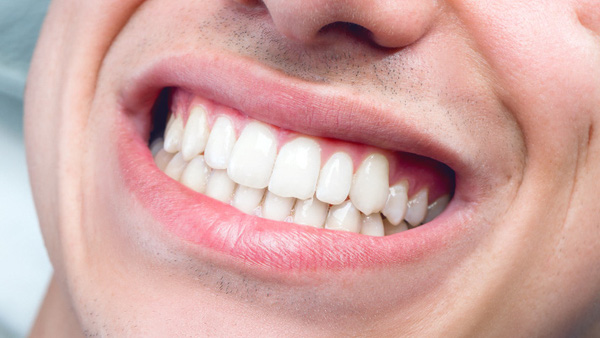 Thường xuyên gõ răng