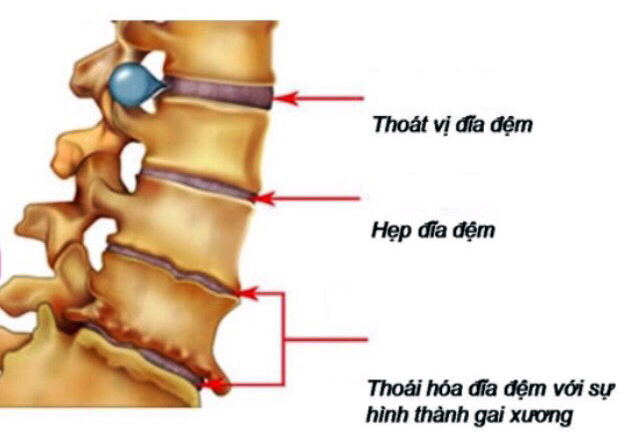 Thoát vị đĩa đệm