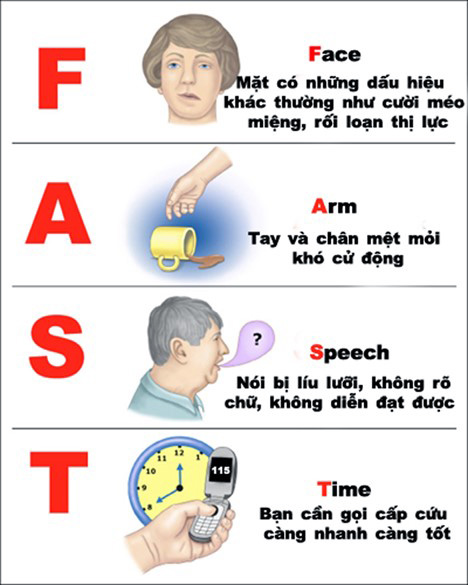 Các chuyên gia y tế, y bác sỹ nhận biết sớm nguy cơ đột quỵ bằng quy tắc FAST