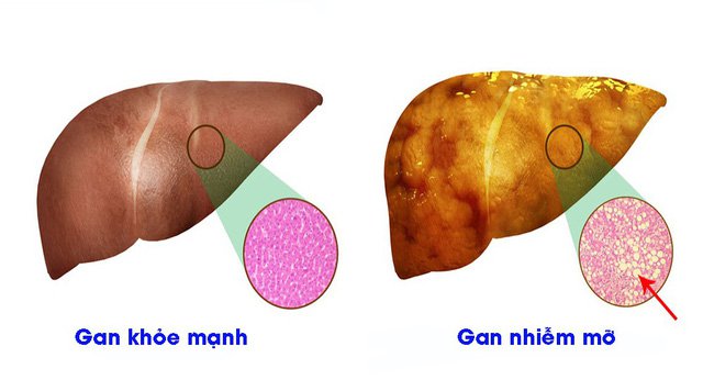 Béo phì và những biến chứng hết sức nguy hiểm