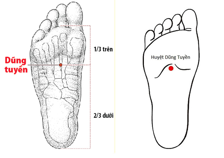 Huyệt Dũng Tuyền loại bỏ chứng thiếu âm, giải nhiệt