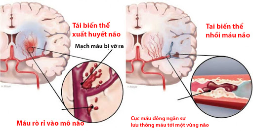 Béo phì và những biến chứng hết sức nguy hiểm