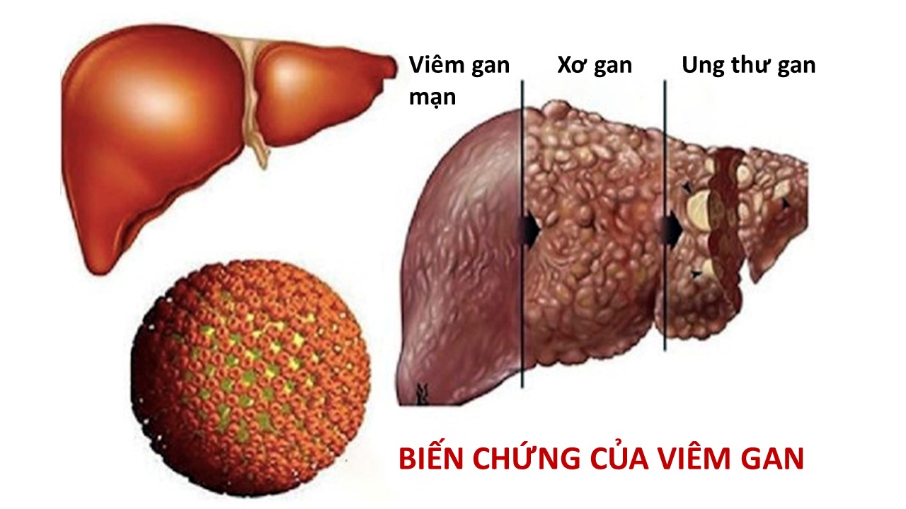 Tiến trình biến chứng viêm gan