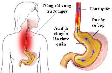 Trào ngược dạ dày thực quản và cách phòng ngừa