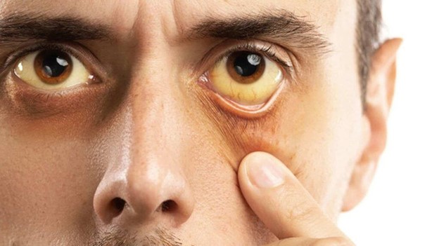 Lòng trắng mắt bị vàng là một trong những biểu hiện điển hình của bệnh ung thư gan