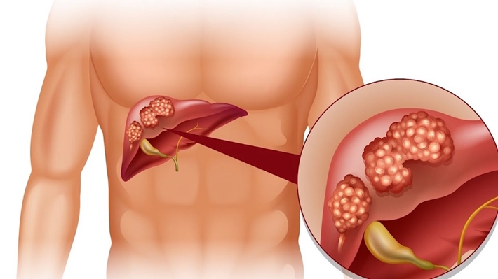 Viêm gan là một trong những tổn thương gan phổ biến hiện nay