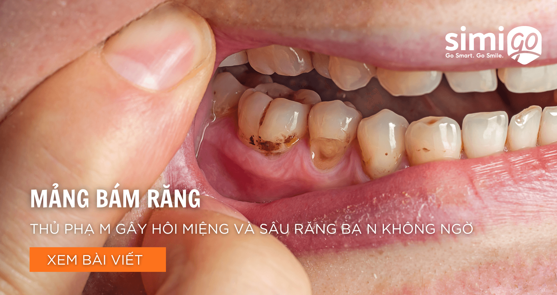 Mảng Bám Răng – Thủ Phạm Gây Hôi Miệng Và Sâu Răng Bạn Không Ngờ