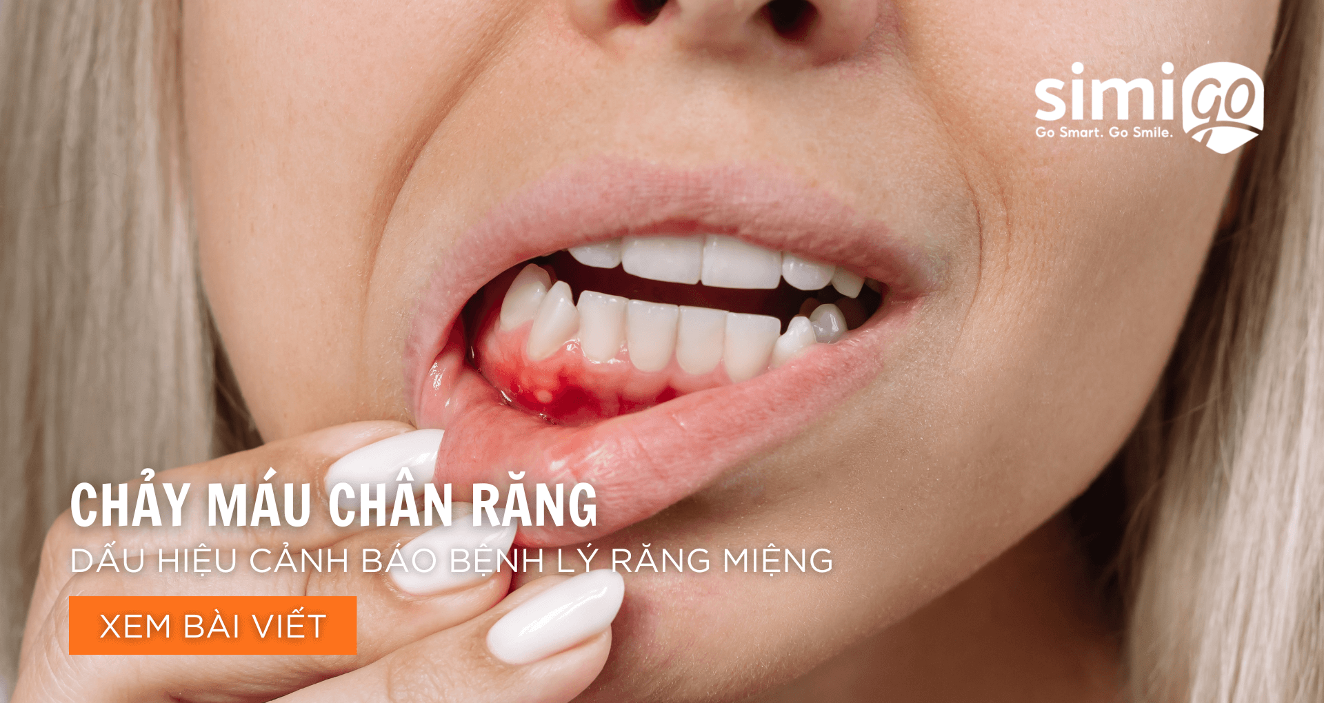 Chảy Máu Chân Răng – Dấu Hiệu Cảnh Báo Bệnh Lý Răng Miệng