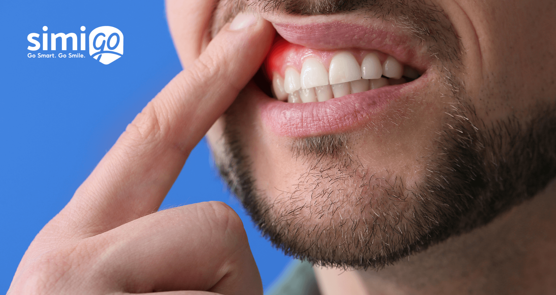 phong-ngua-va-dieu-tri-viem-nuou-rang-don-gian-ngay-tai-nha