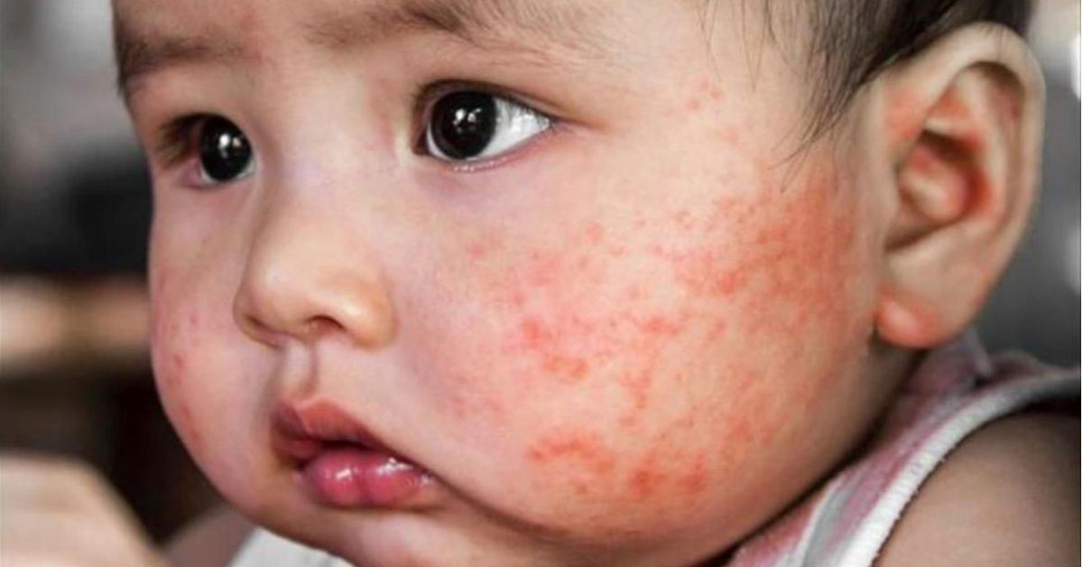 BÔI THUỐC GÌ CHO TRẺ SƠ SINH BỊ CHÀM SỮA Ở MẶT ?
