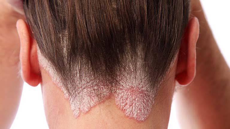 ĐIỀU TRỊ DA ĐẦU BỊ KHÔ BONG TRÓC TẠI NHÀ NHƯ THẾ NÀO 