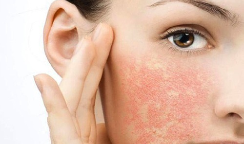 PEEL DA TRỊ MỤN CÓ TỐT KHÔNG CẦN LƯU Ý NHỮNG GÌ 