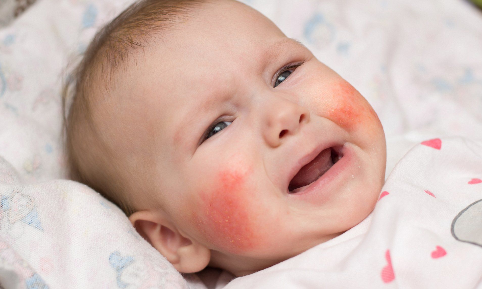 Chàm sữa thường có ở hai bên má trẻ, sau có thể lan xuống cằm và các bộ phận khác (nguồn ảnh: Internet)