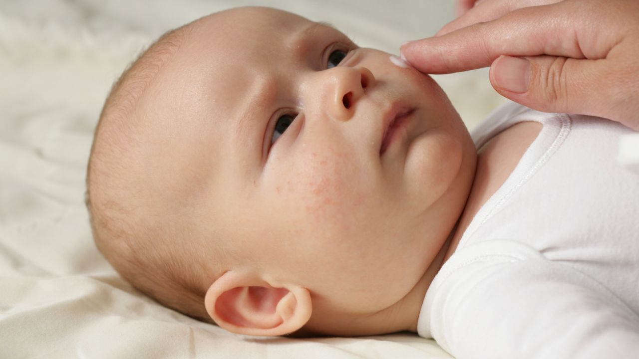 Mẹ nên sử dụng các sản phẩm chăm sóc da cho bé để cải thiện tình trạng bệnh (nguồn ảnh: Internet)