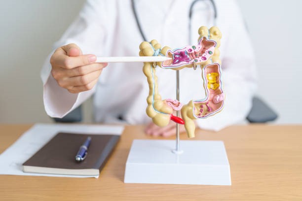 Vi khuẩn đường ruột của người trẻ có thể dẫn đến nguy cơ ung thư đại trực tràng