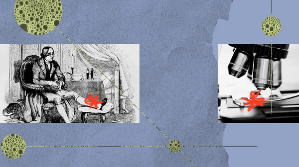 Bệnh gút có thể do thiếu hụt một loại protein có trong dịch khớp. Bệnh gút có thể do thiếu hụt một loại protein có trong dịch khớp.