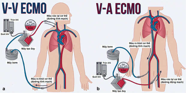 ECMO (Tim phổi nhân tạo)