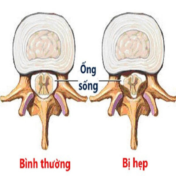 Hẹp ống sống