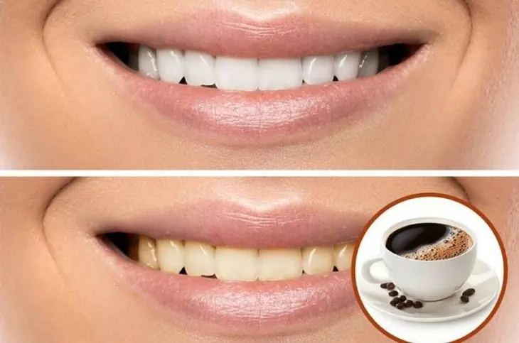 Cà phê gây ra vết ố vàng trên bề mặt men răng