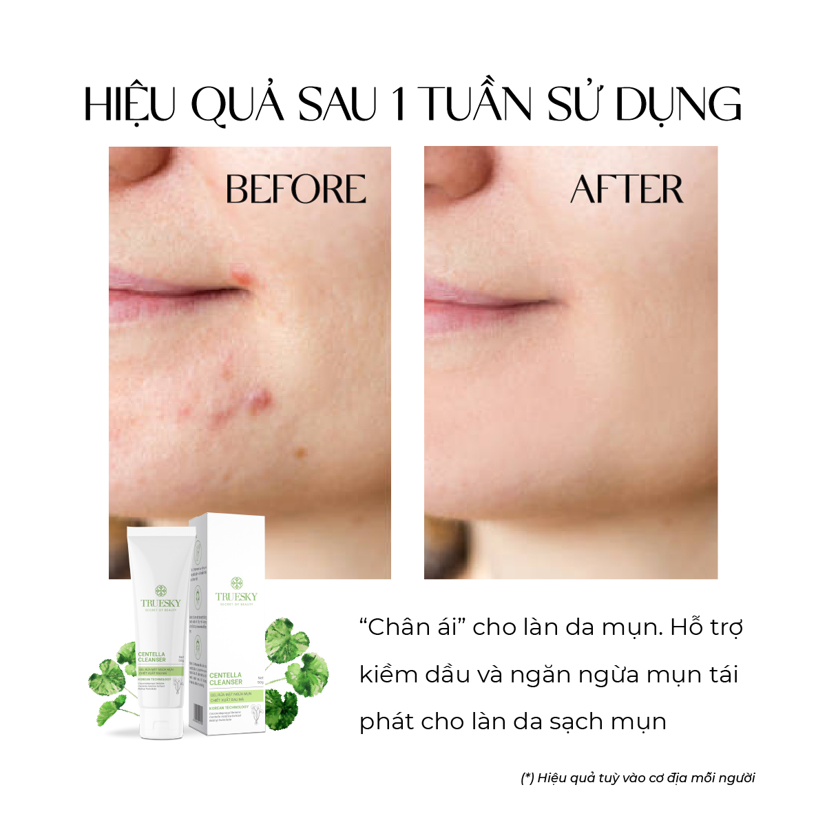 Gel rửa mặt ngăn ngừa mụn Truesky Centella Cleanser chiết xuất rau má 50g