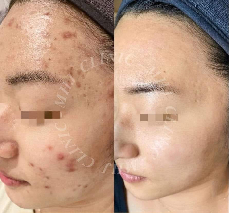 [ Góc Review ] Sạch Bay Thâm Mụn Nhờ Liệu Trình Laser & Bôi Thoa