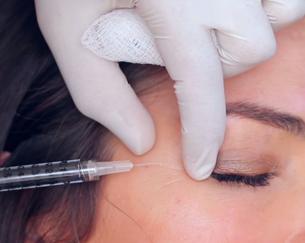 Botox xóa nhăn vùng đuôi mắt