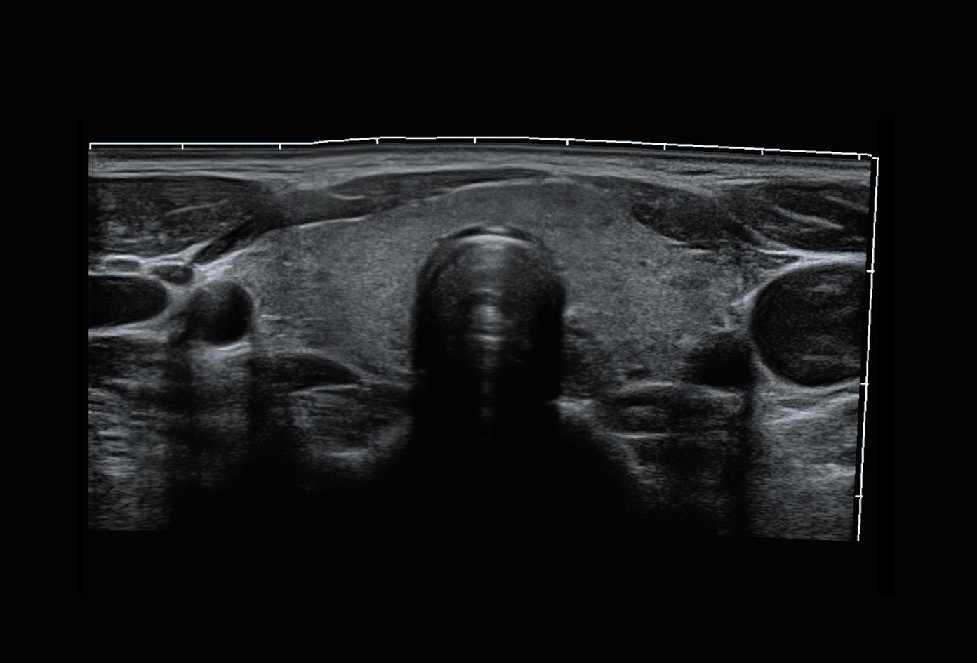 Máy siêu âm 5D Sonoscape P10 Plus