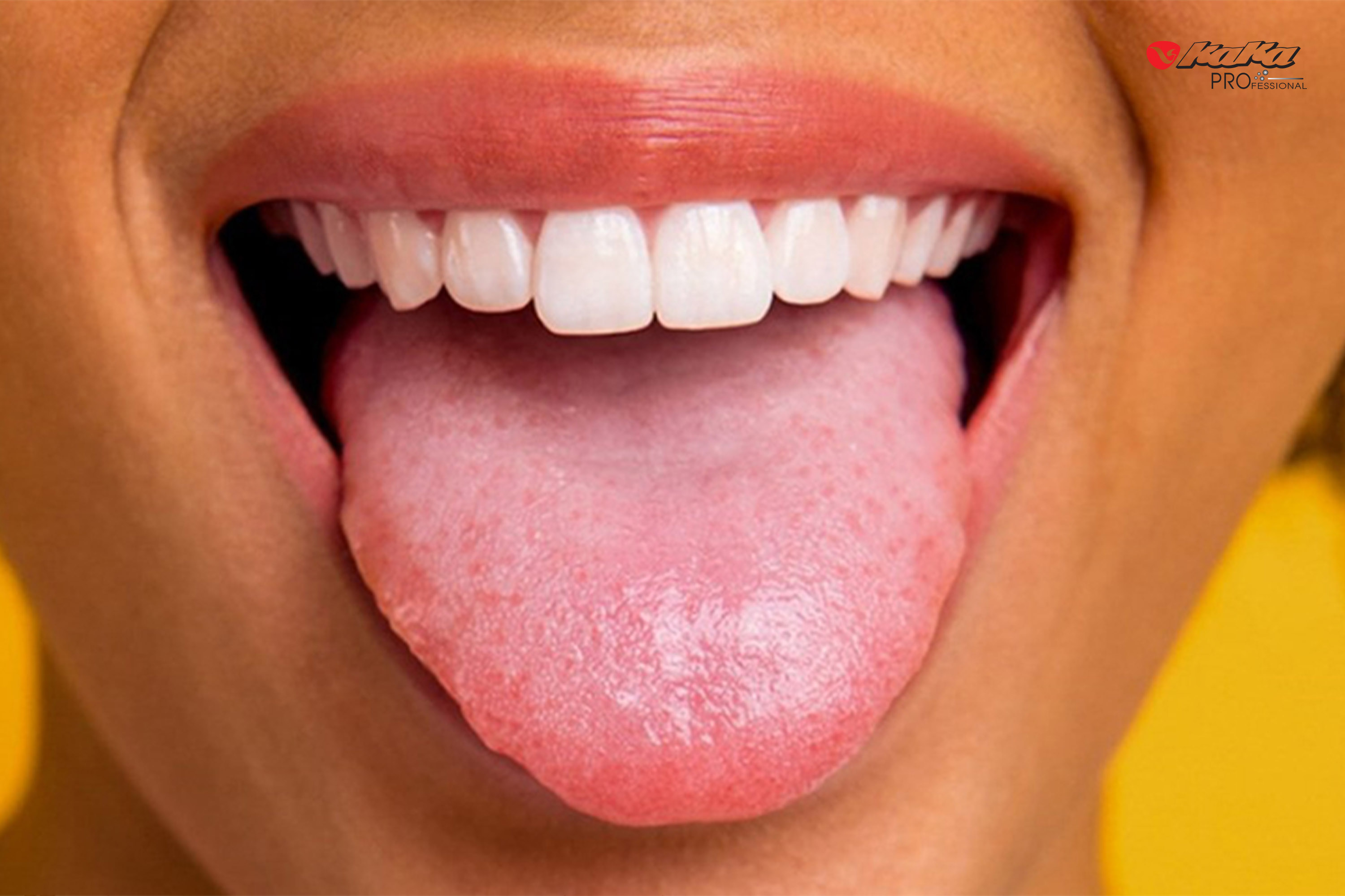 Không làm sạch bề mặt lưỡi cũng là nguyên nhân gây hôi miệng