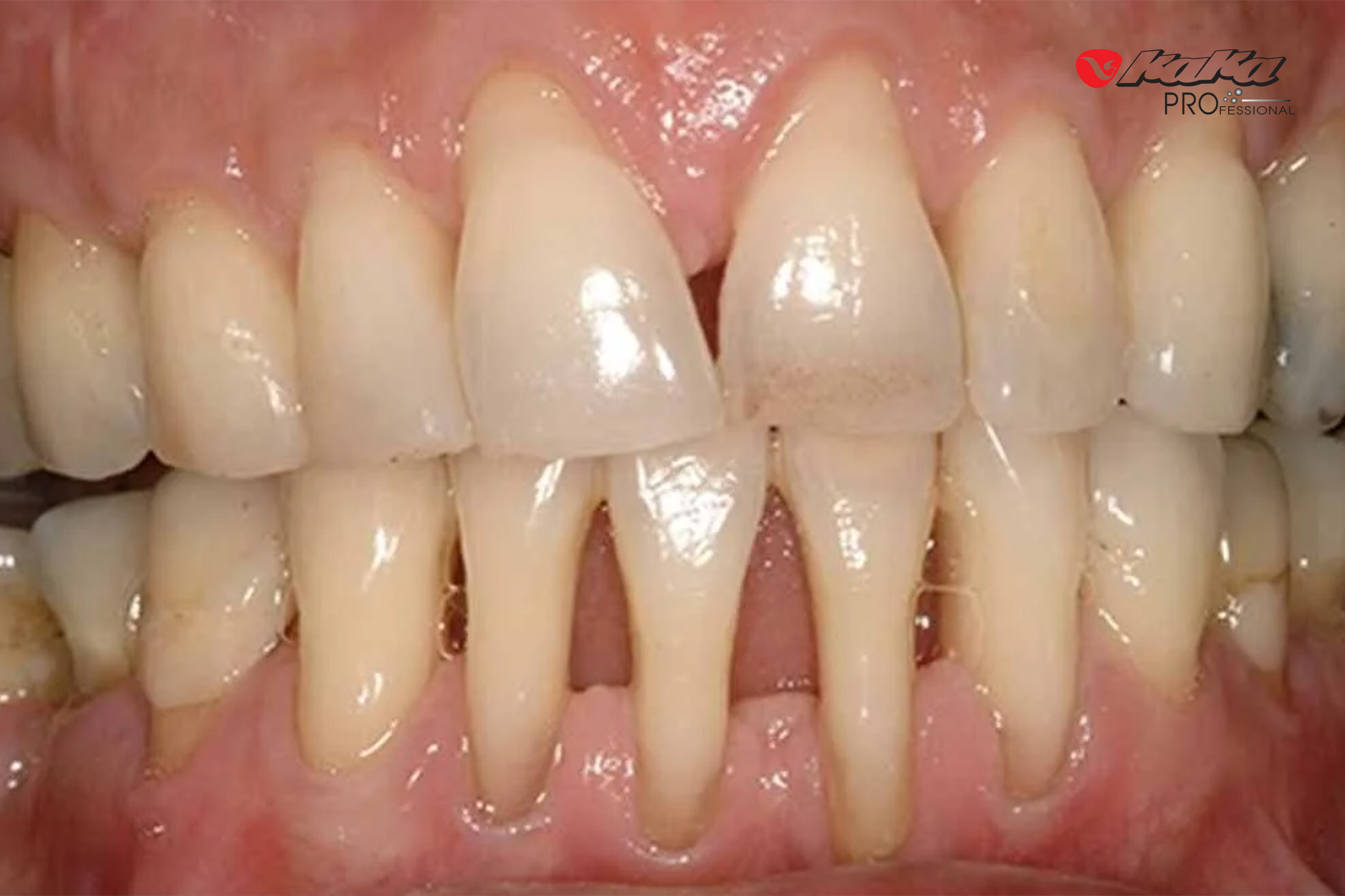 Tình trạng tụt nướu dẫn đến ê buốt chân răng