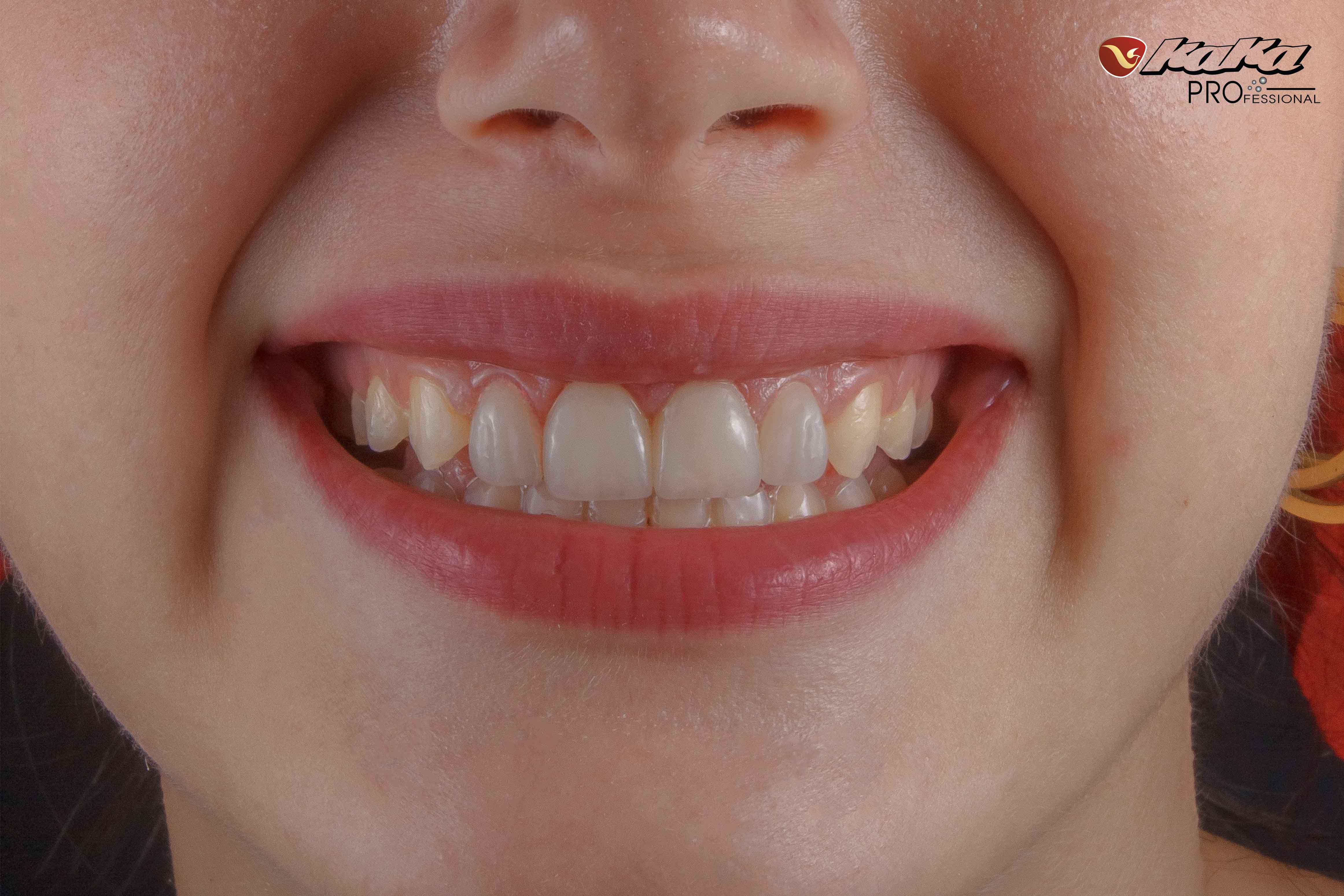 Tự tin khoe cá tính khi sở hữu hàm răng trắng sáng