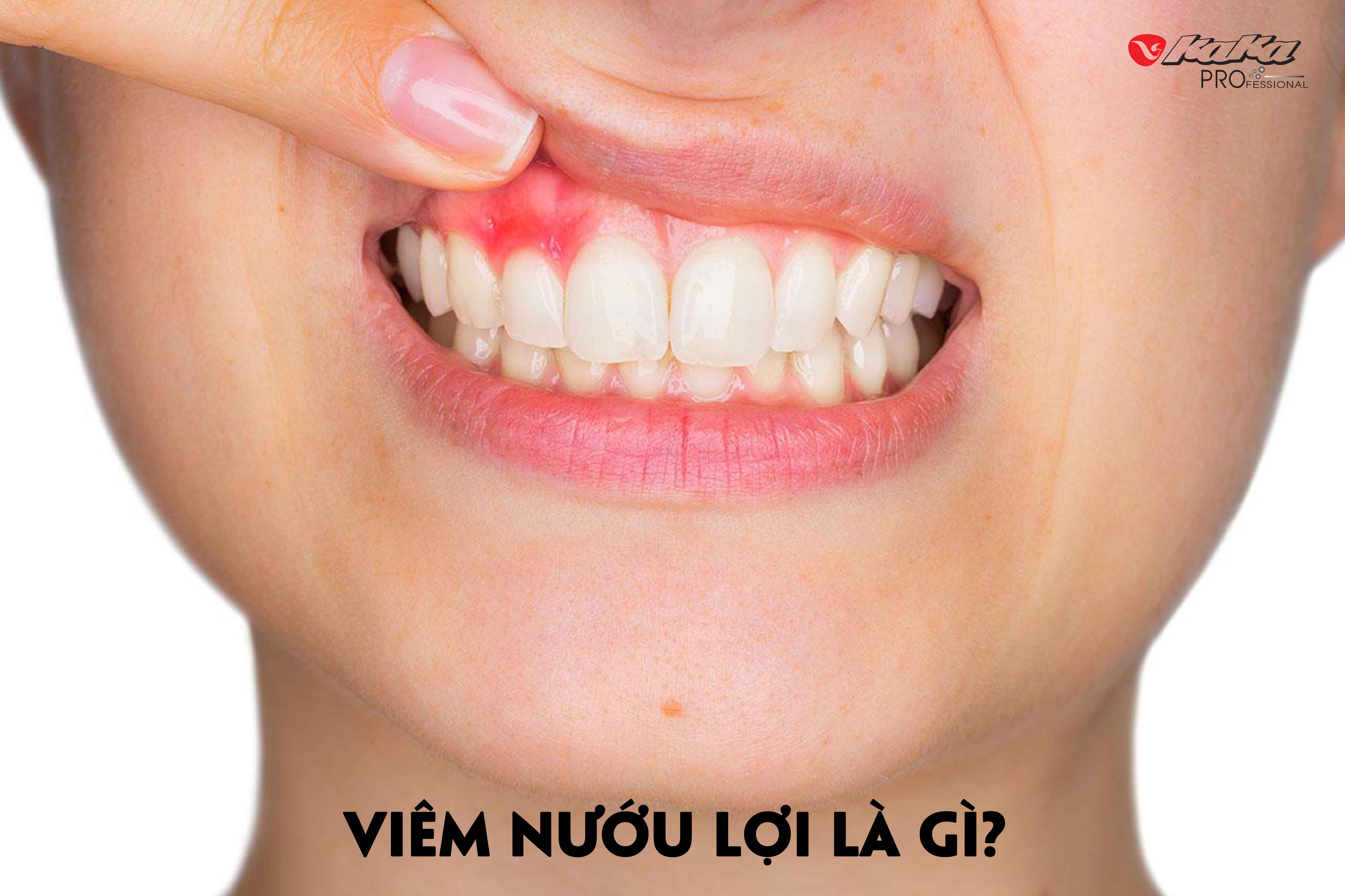 Viêm nướu răng là gì?