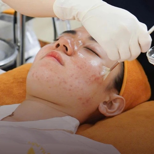 top-spa-tot-nhat-tphcm-chuyen-ve-dieu-tri-mun-cho-tuoi-day-thi