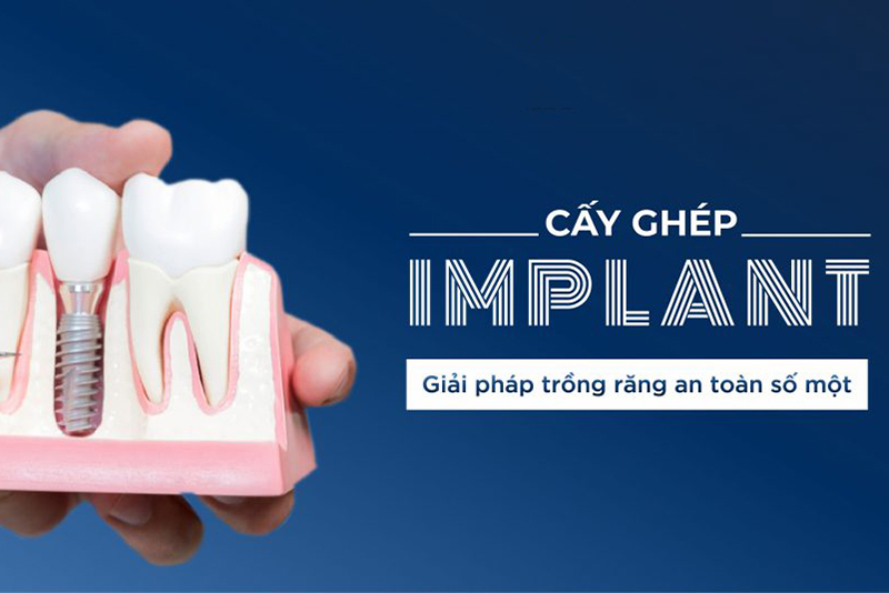 CẤY GHÉP IMPLANT