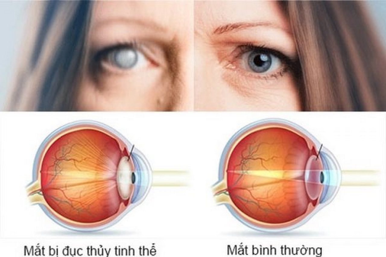 Các bệnh về mắt của người già