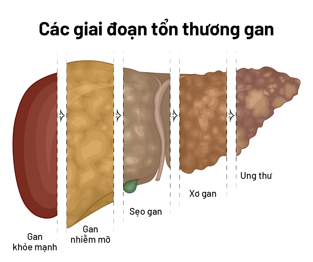 Gan nhiễm mỡ độ 1: Nguyên nhân và các dấu hiệu bệnh