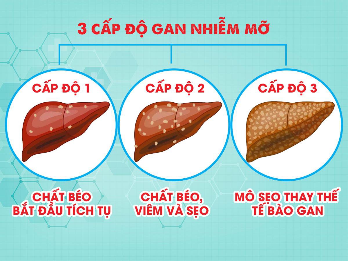 Gan nhiễm mỡ độ 1: Nguyên nhân và các dấu hiệu bệnh