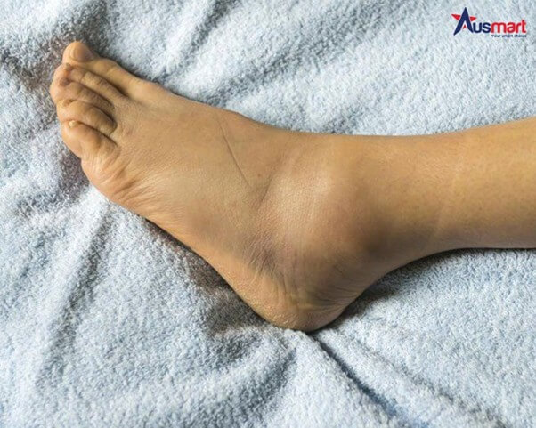 Bàn chân bị tích nước, sưng phù