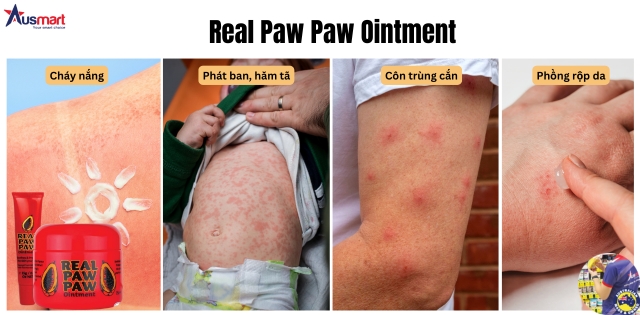 Sử dụng Kem Real Paw Paw Ointment trị cháy nắng, hăm tã, côn trùng cắn và phồng rộp