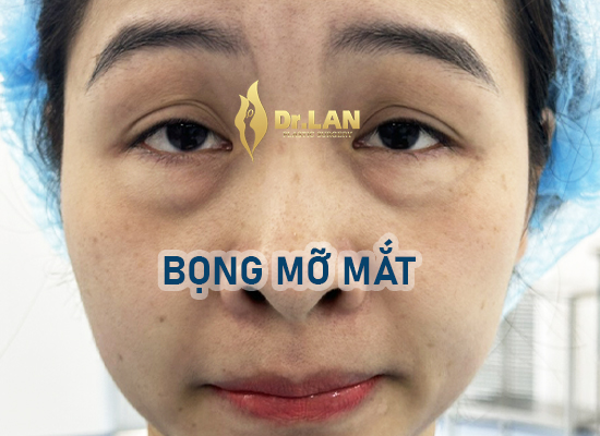 BỌNG MỠ MÍ DƯỚI: GIẢI PHÁP CẮT BỌC BỌNG MỠ ĐƯỜNG KẾT MẠC – KHÔNG SẸO, TRẺ HÓA TỰ NHIÊN