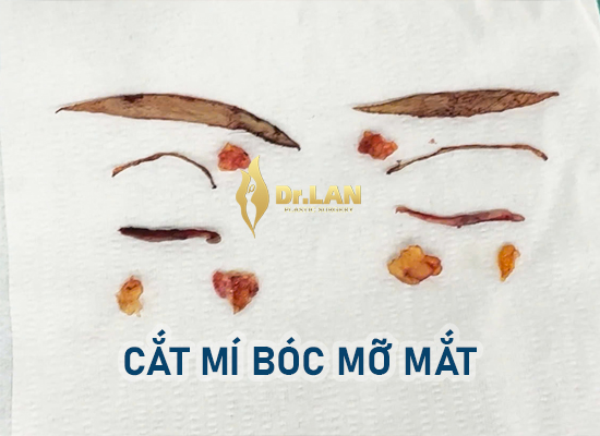 Cắt mí mắt có để lại sẹo không? Chia sẻ thực tế từ khách hàng và giải đáp từ bác sĩ