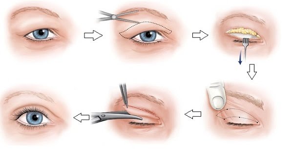 Cắt mí Hàn Quốc và những điều cần biết