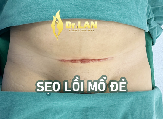 Sẹo Mổ Đẻ Lồi Cao Và Đỏ Rực: Vì Sao Xảy Ra Và Làm Sao Để Cải Thiện?