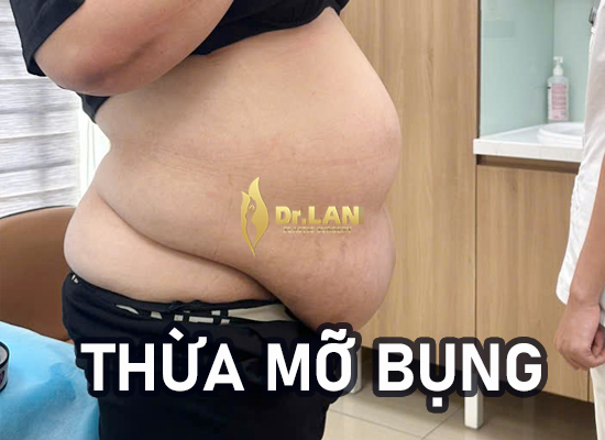 Tạo hình thành bụng có đau không và mất bao lâu để hồi phục? Chia sẻ từ khách hàng và bác sĩ giải đáp