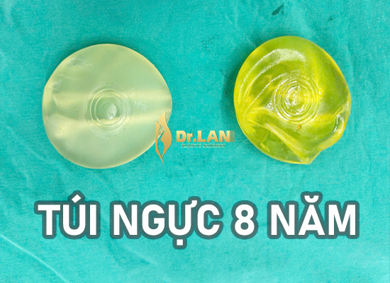Vòng 1 “không còn là niềm vui” sau 8 năm đặt túi ngực - câu chuyện của Hiền, 27 tuổi – Nam Định