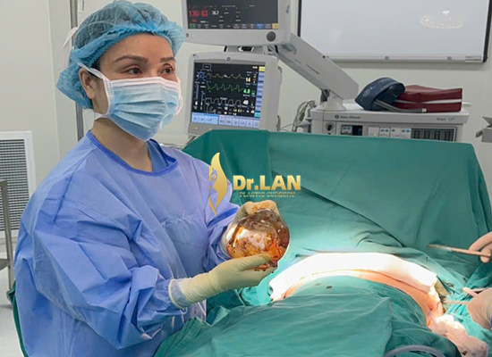 Thay túi ngực hay tháo túi – lựa chọn nào an toàn hơn?