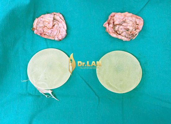 Chi phí thay túi ngực bao nhiêu?