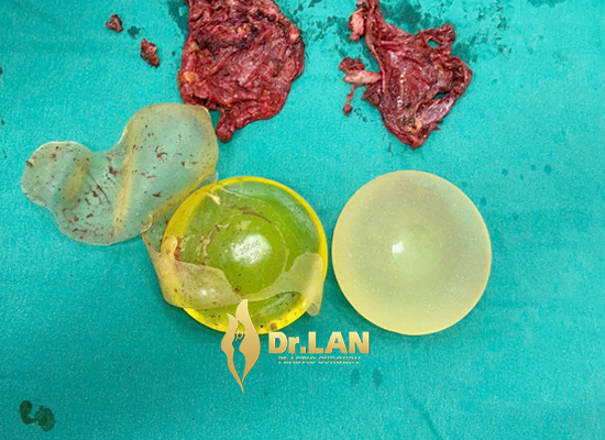 Khi nào cần thay túi ngực?