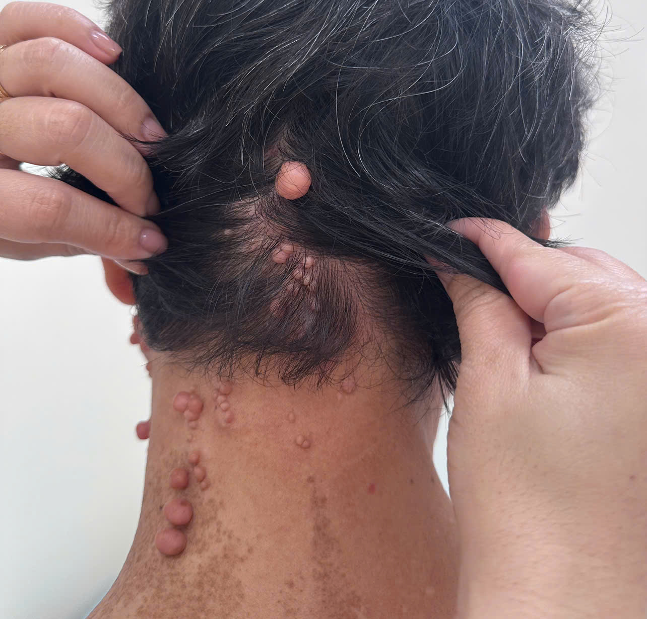Phẫu thuật thẩm mỹ cho người bệnh u xơ thần kinh - TS.BS Hoàng Thị Phương Lan
