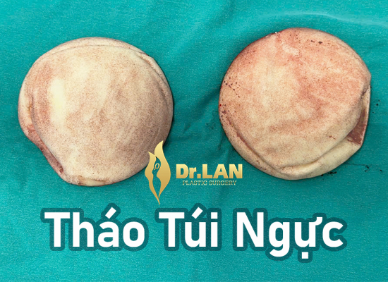 Khi tuổi túi ngực và công việc khiến vòng 1 trở nên nặng nề - Trải nghiệm của Mai, 31 tuổi – Hải Phòng